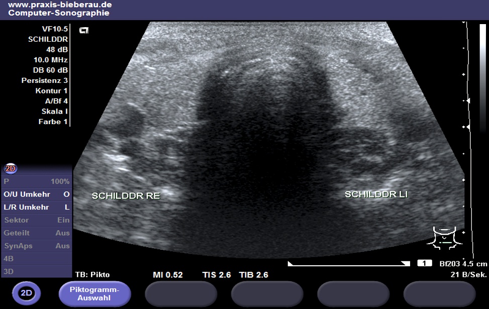 Ultraschall-Bild der Schilddrüse